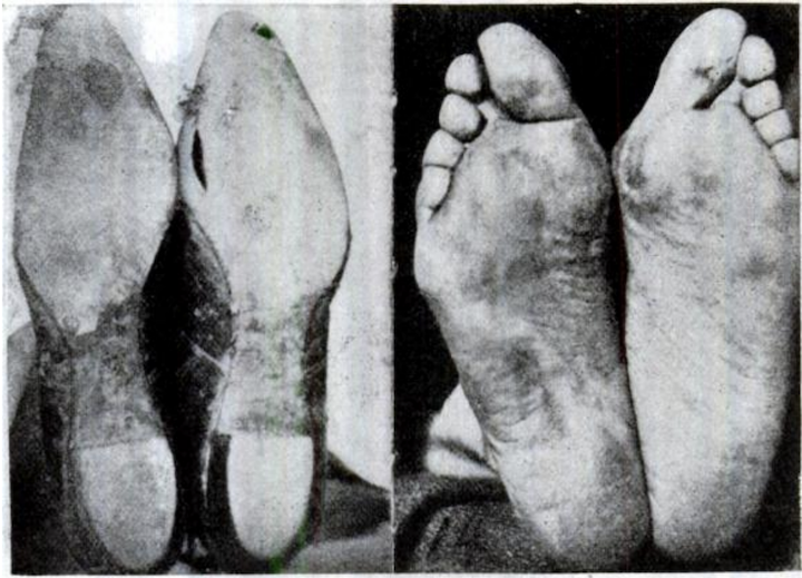 Feet, shaped by shoes
