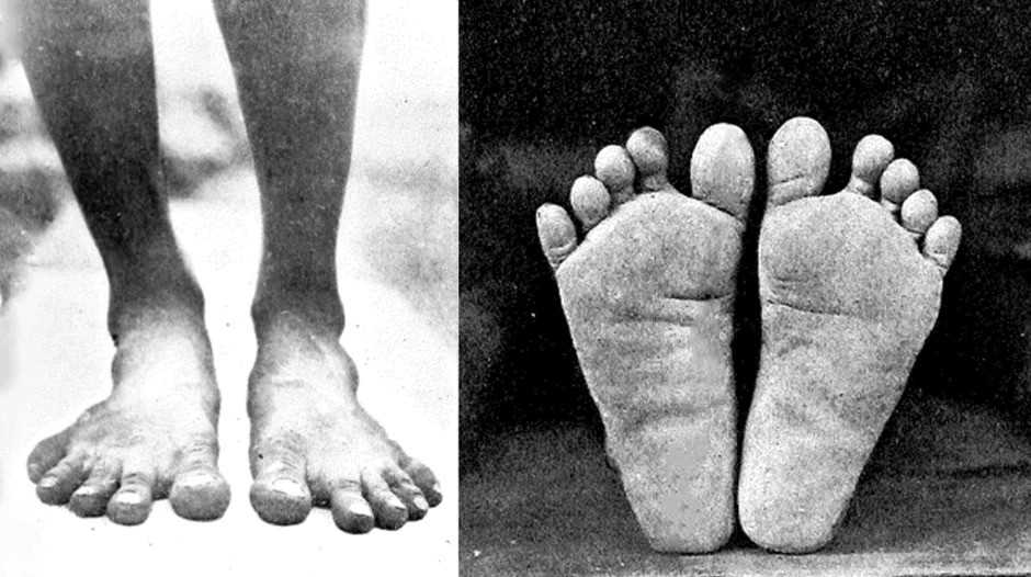 Feet form, natural vs shaped